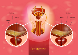 Prostatite