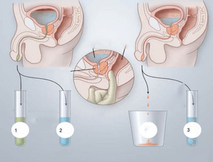 massage de la prostate