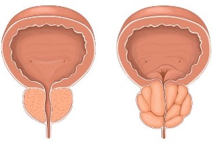 Prostatite