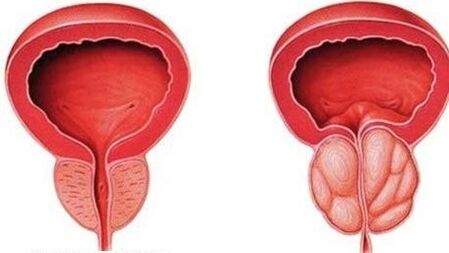 prostate normale et enflée