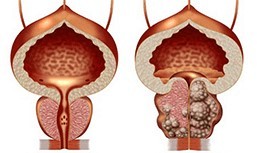 Saine et malsaine de la Prostate