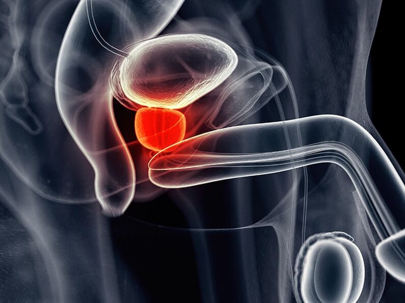 Inflammation de la prostate qui accompagne la prostatite chronique.