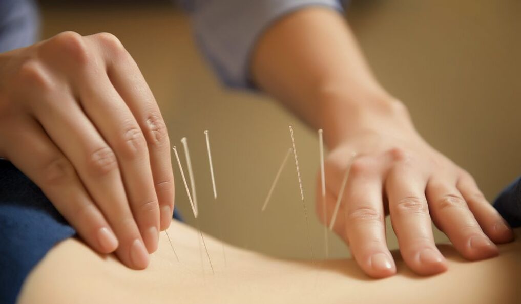 L'acupuncture est une méthode courante de traitement de la prostatite chronique.